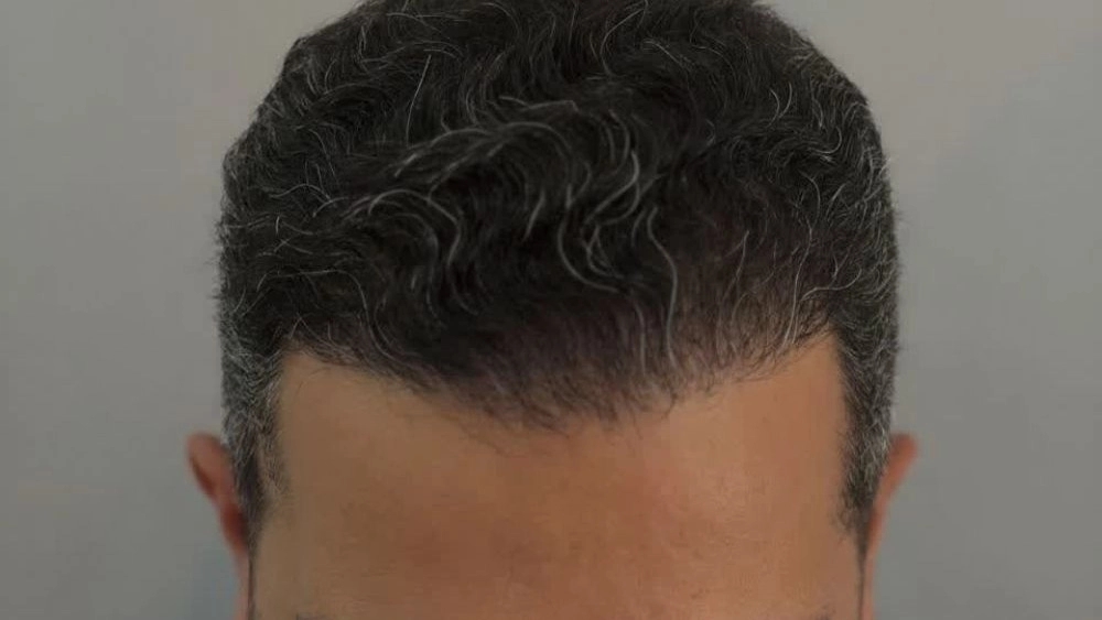 مرکز کاشت رشت رویان، خدمات تخصصی کاشت مو و ابرو به روش میکروگرافت