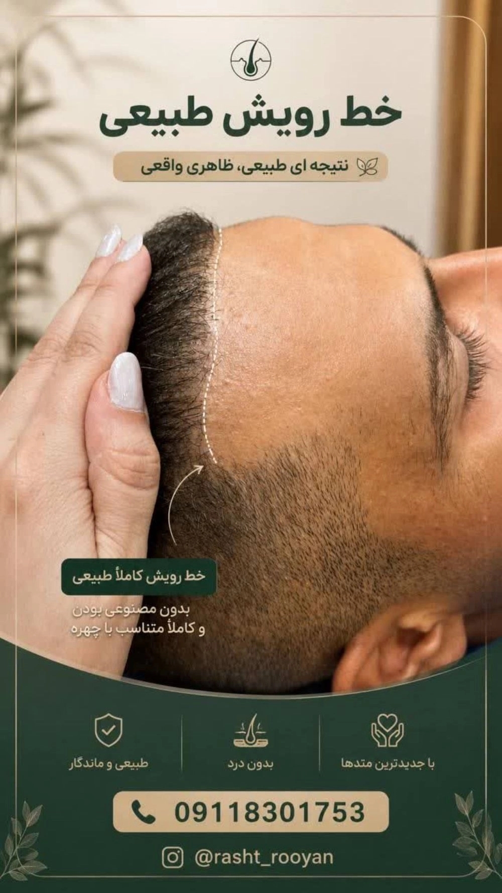 کاشت مو به روش میکروگرافت