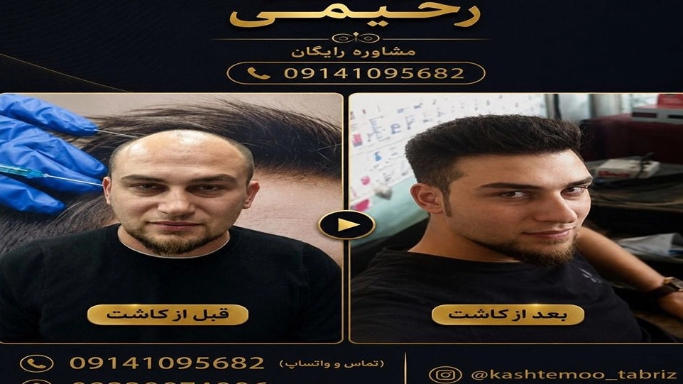 کلینیک تخصصی کاشت مو رحیمی، خدمات کاشت مو و ابرو در تبریز