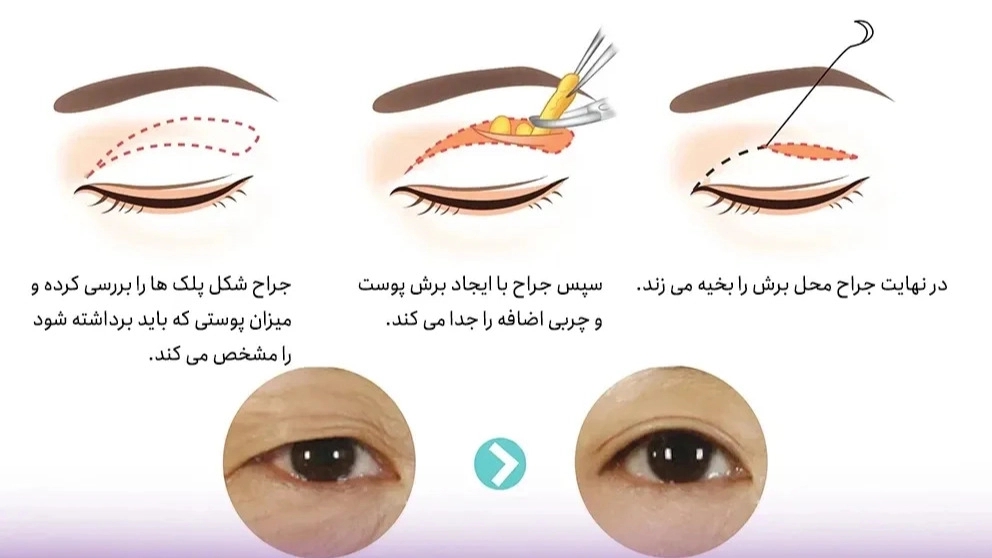 بلفاروپلاستی چیست؟