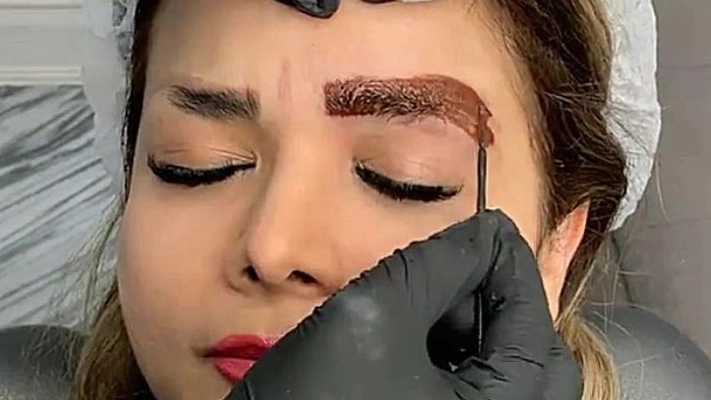 ریموو تتو قدیمی در حاجی بکنده