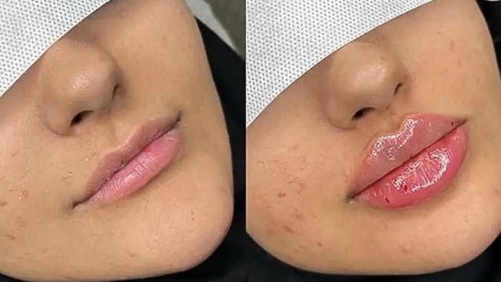 کلینیک زیبایی مای نا، ارائه خدمات ژل بوتاکس فیلر مزوتراپی و پی آرپی در کرمانشاه