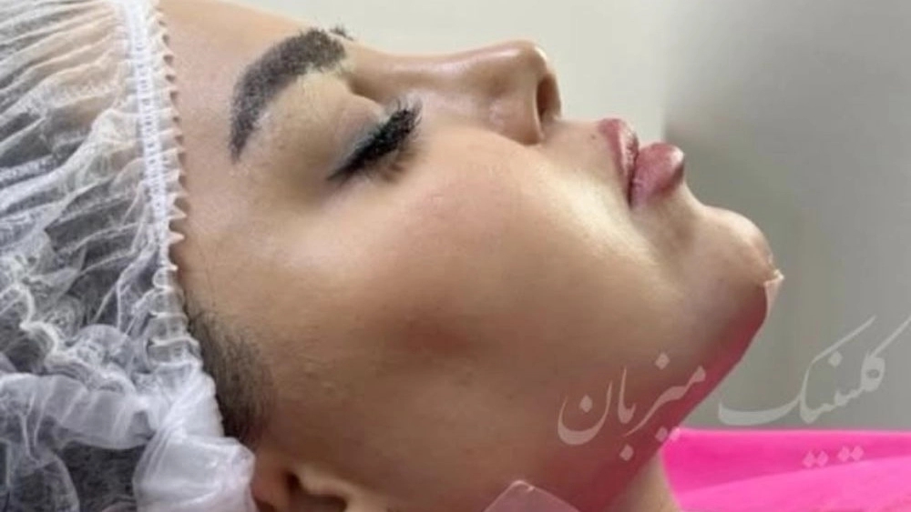 بهترین متخصص تزریق فیلر در تهران