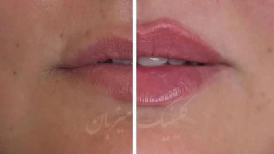 تزریق ژل و بوتاکس با نچرال‌ ترین نتایج نچرال در تهران