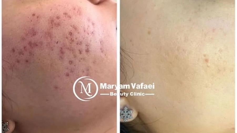 فیشیال وفایی، خدمات درمانی پوست جای جوش و مزو در گچساران