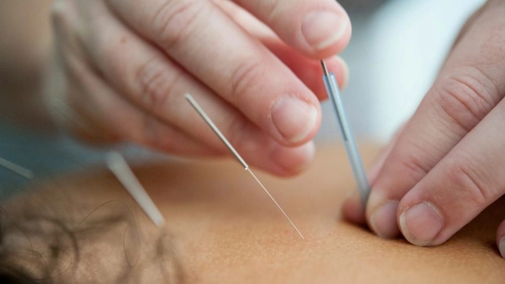 خدمات طب سوزنی دکتر شادمان، لاغری با کاشت نخ در تهران