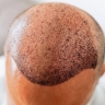 کلینیک روغن کران، خدمات کاشت مو ابرو و ریش در شیراز