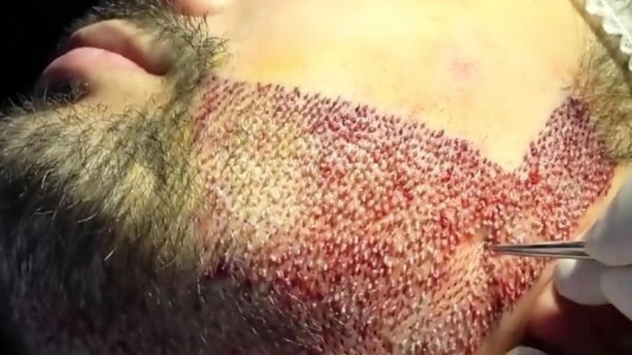 کاشت ریش و سبیل در کلینیک روغن کران شیراز