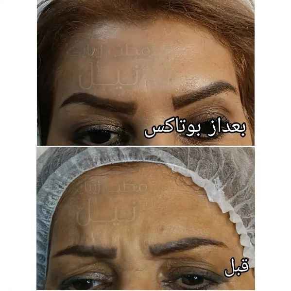 بوتاکس
