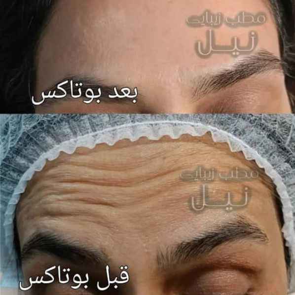 بوتاکس