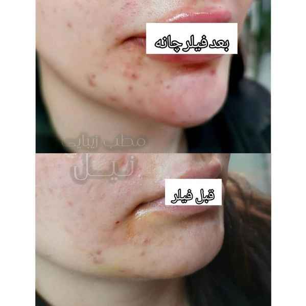 فیلر چانه