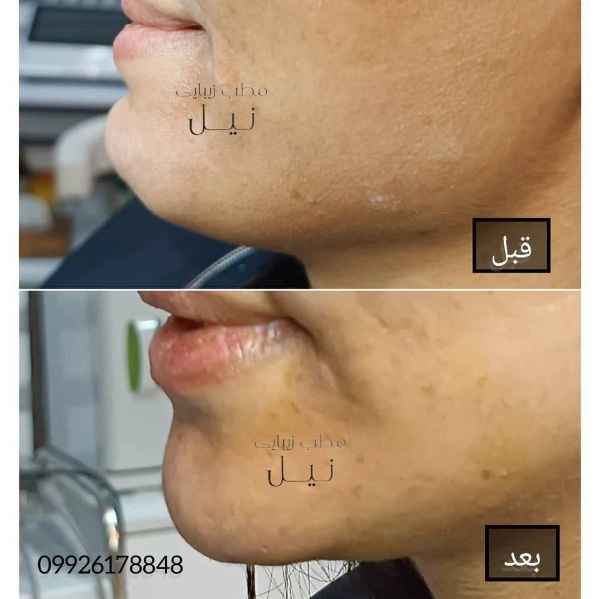 فیلر خط لبخند