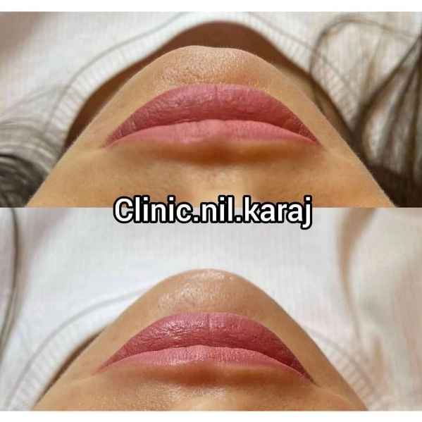 فیلر چانه