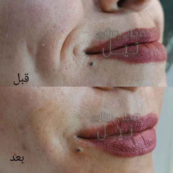 فیلر خط لبخند