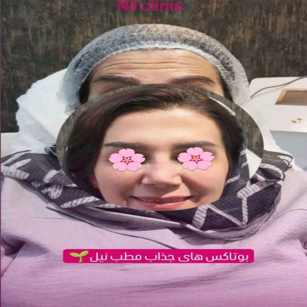 بوتاکس زیبا جوی خانم