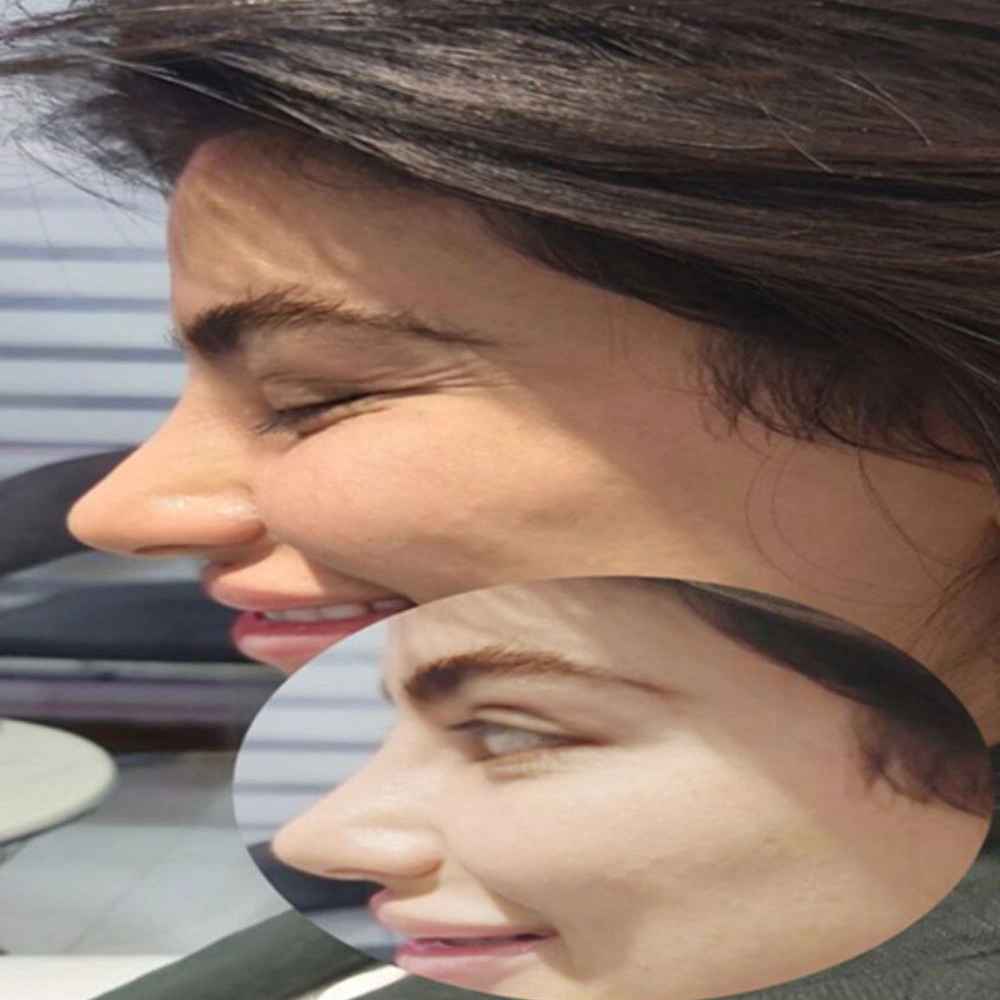 بوتاکس رفع پنجه کلاغی زیبا جو