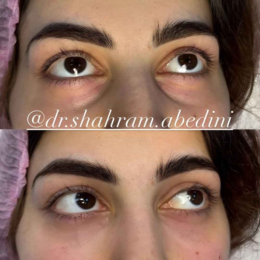 هزینه تزریق ژل لب