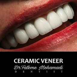 کلینیک دندانپزشکی دکتر فاطمه محمدی، لمینت ایمپلنت در اصفهان