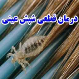 درمان قطعی شپش عینی در تهران