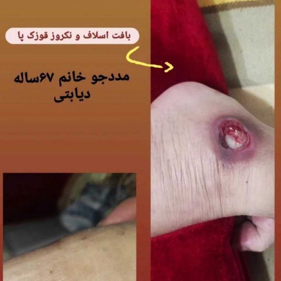 درمان زخم دیابتی در منزل بندر انزلی با خدمات ماما محدثه شمشادی