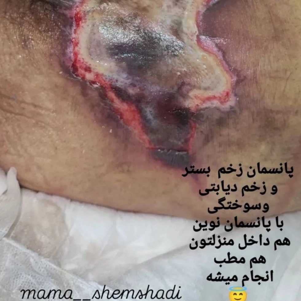 نقش پرستار خانگی در پیشگیری از عفونت زخم دیابتی