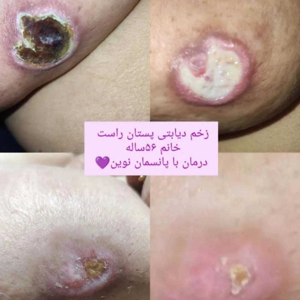 مراحل درمان زخم پای دیابتی در منزل به‌صورت حرفه‌ای