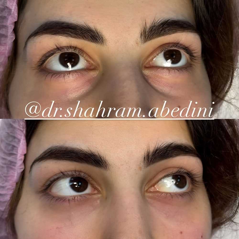 هزینه تزریق ژل لب