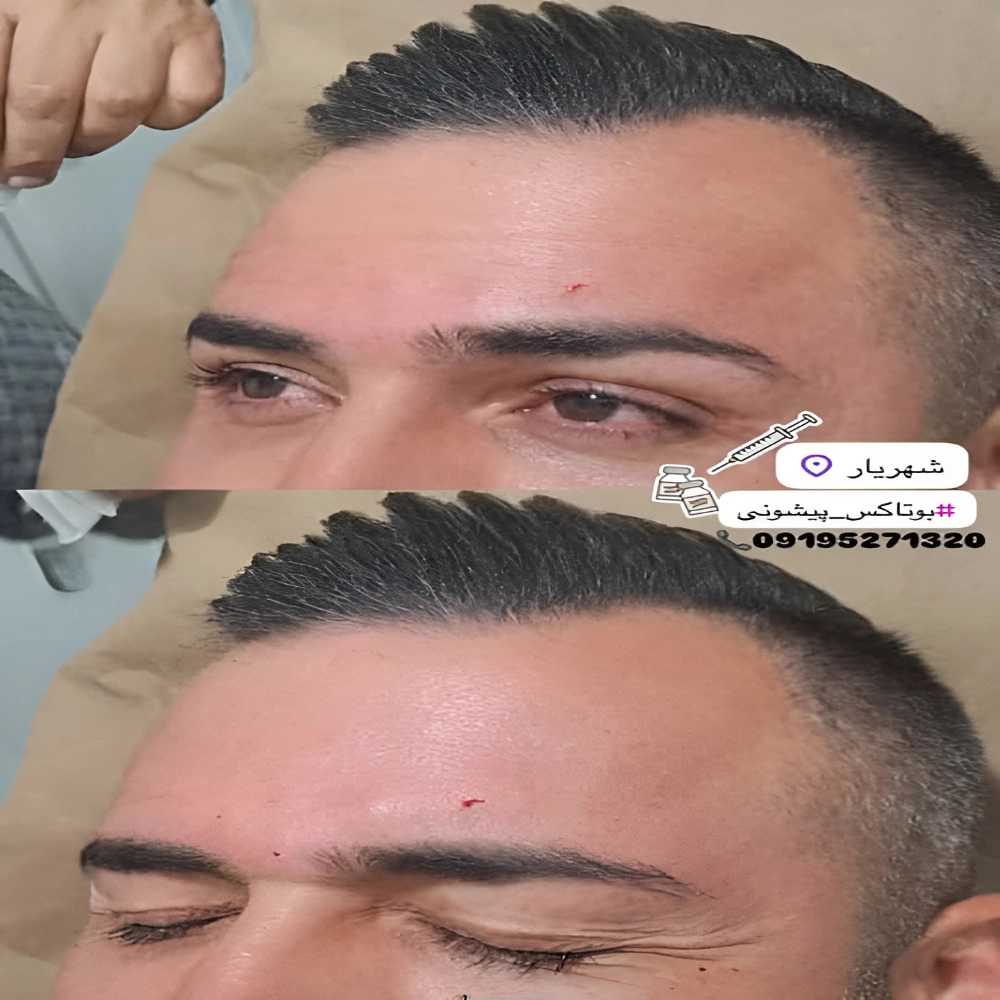 مزوتراپی مو