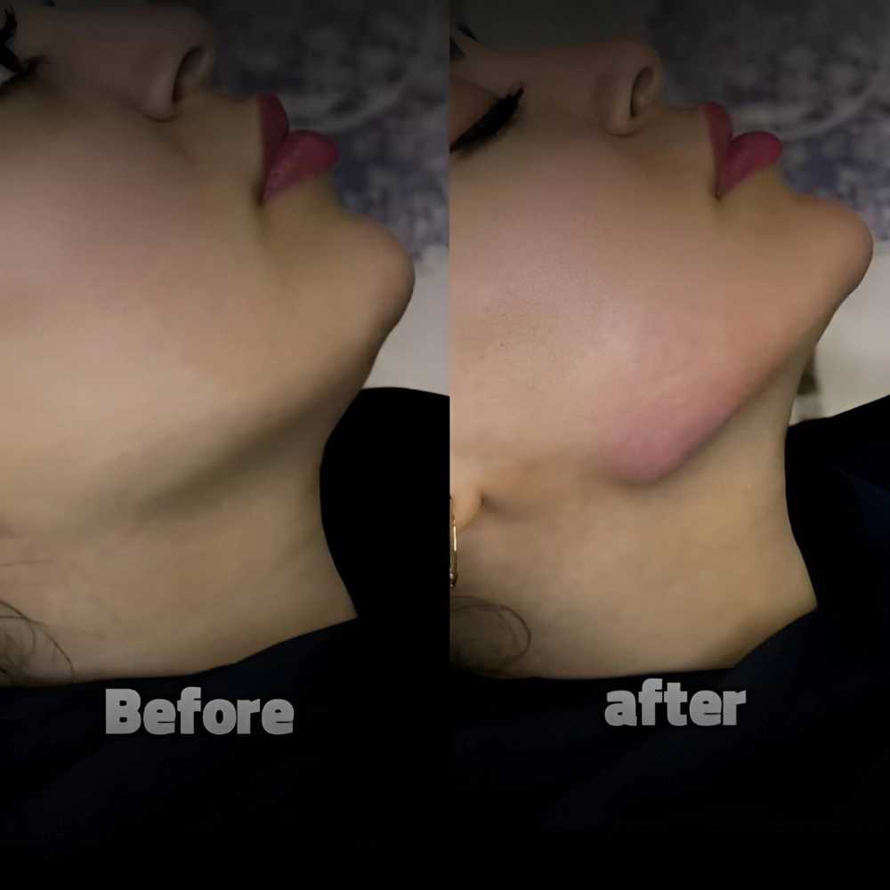مزونیدلینگ صورت