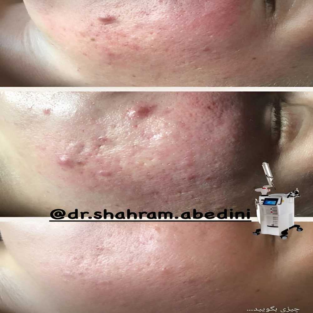 فیلر زیر چشم