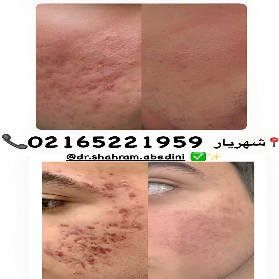 تزریق ژل چانه
