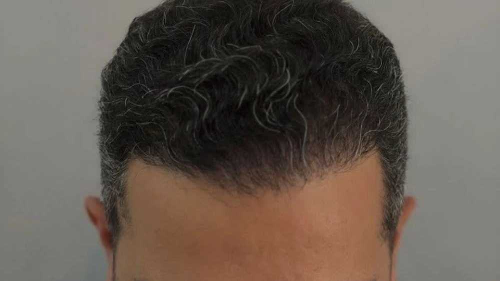 مرکز کاشت رشت رویان، خدمات تخصصی کاشت مو و ابرو به روش میکروگرافت