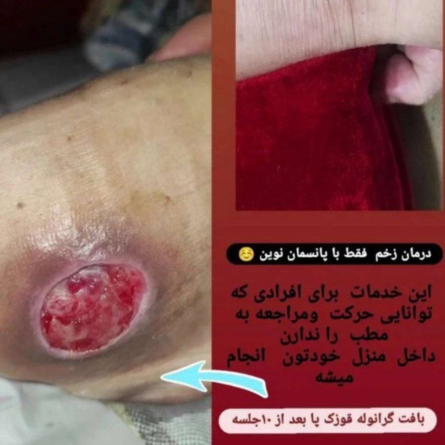 اهمیت مراقبت خانگی در بهبود زخم‌های دیابتی در بندر انزلی