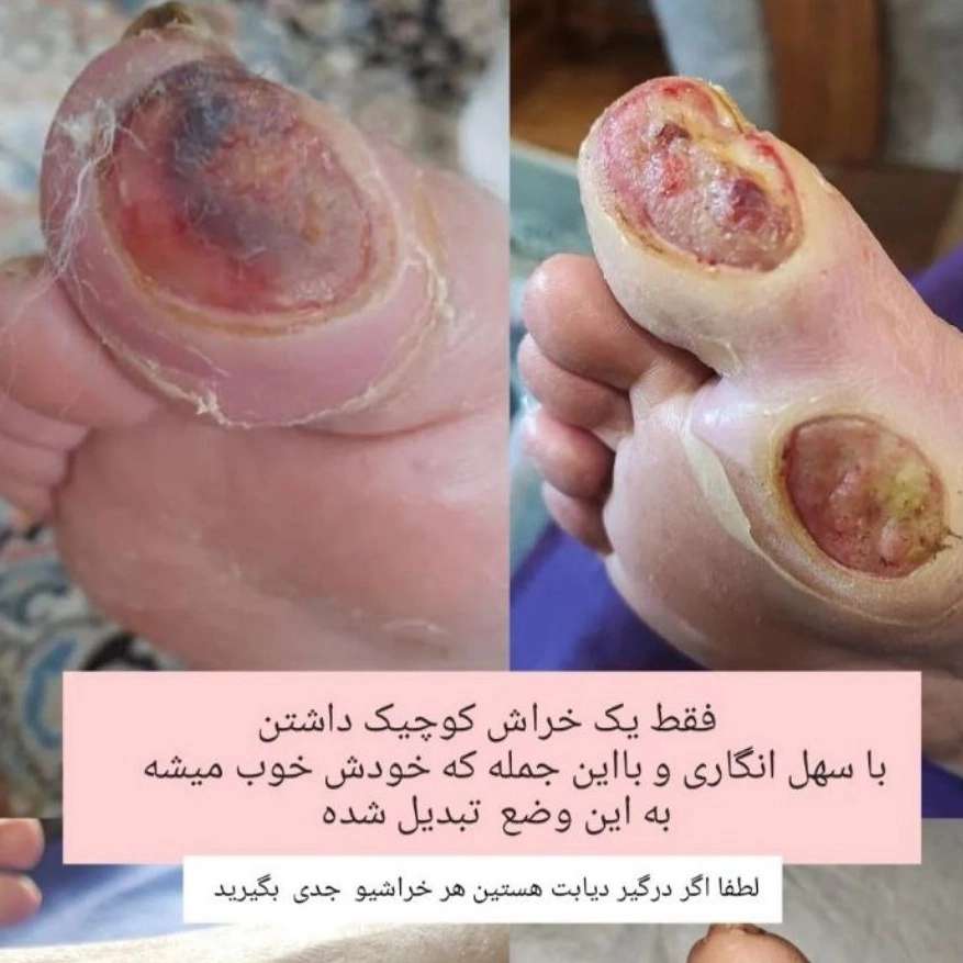 چرا درمان زخم دیابت در منزل گزینه‌ای مطمئن در بندر انزلی است؟