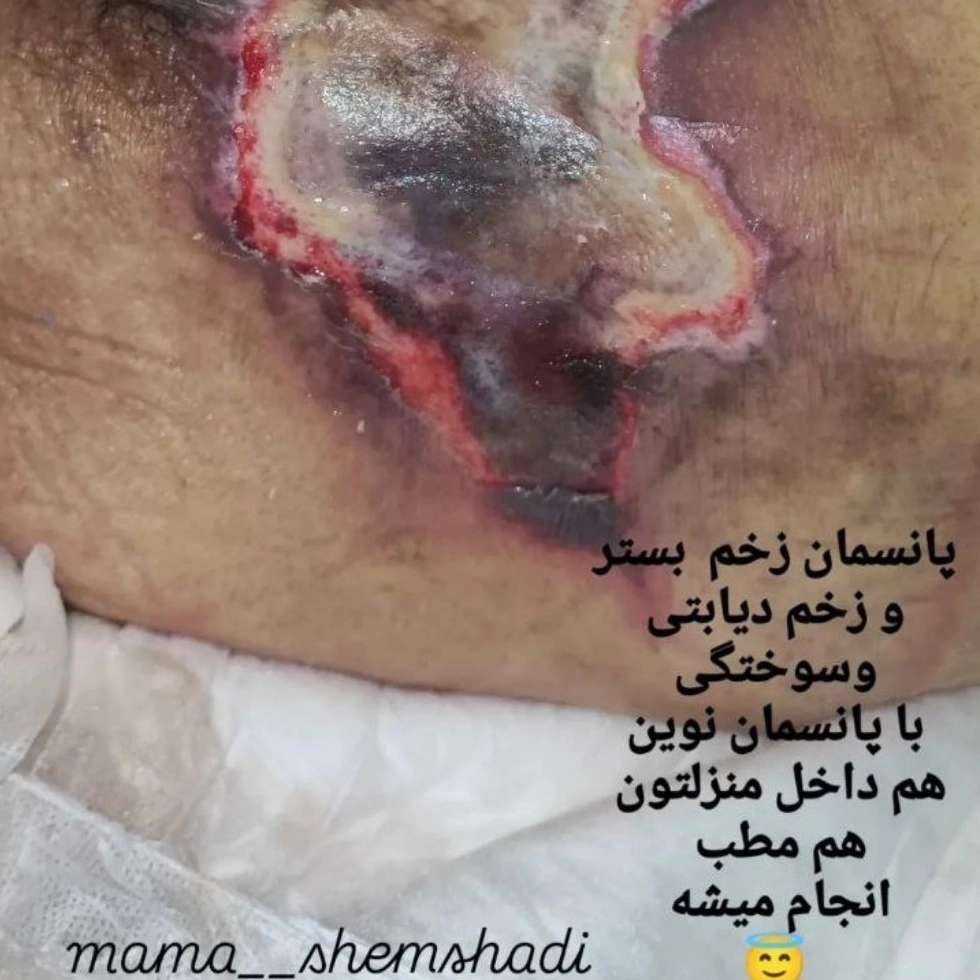 نقش پرستار خانگی در پیشگیری از عفونت زخم دیابتی