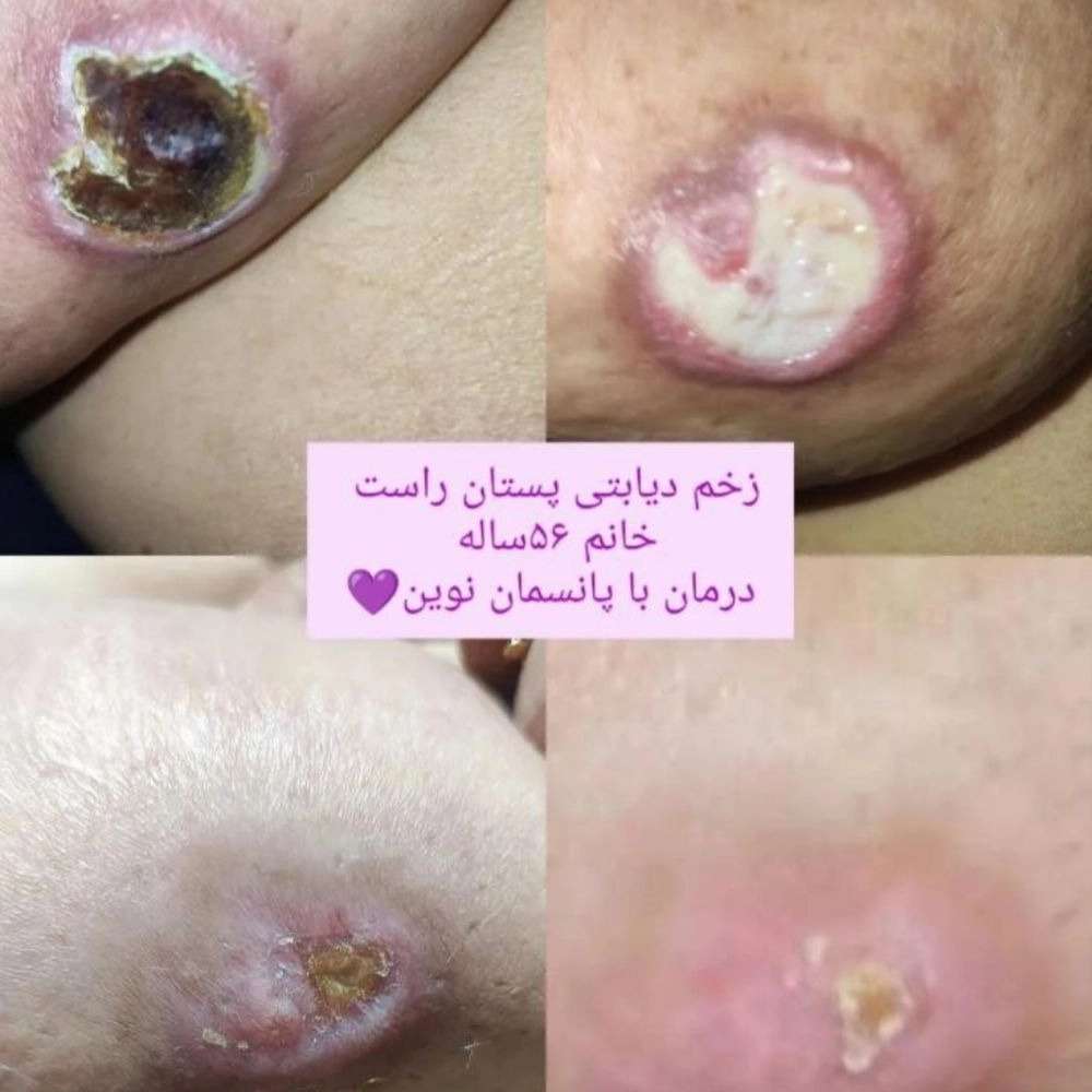 مراحل درمان زخم پای دیابتی در منزل به‌صورت حرفه‌ای