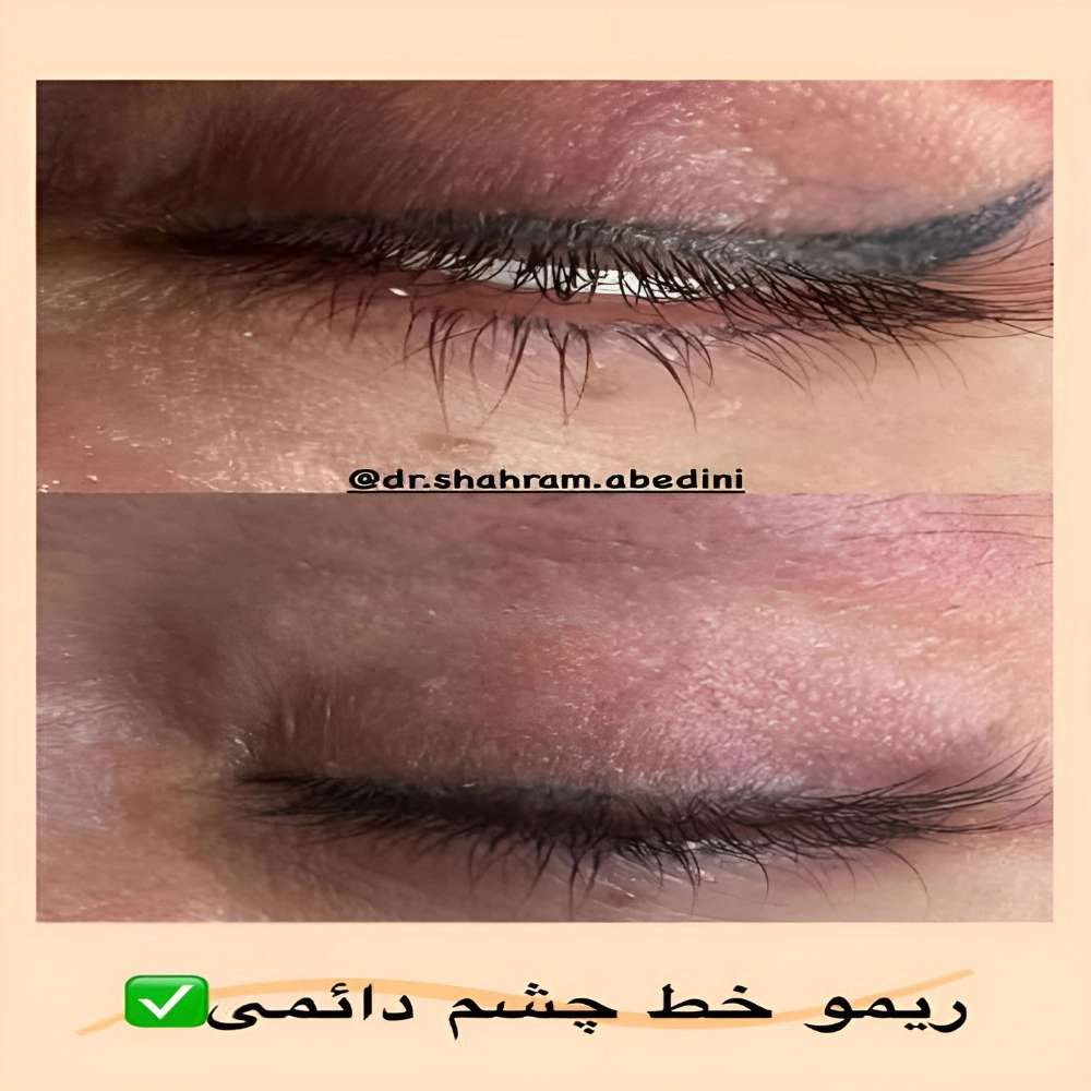 هزینه کاشت مو