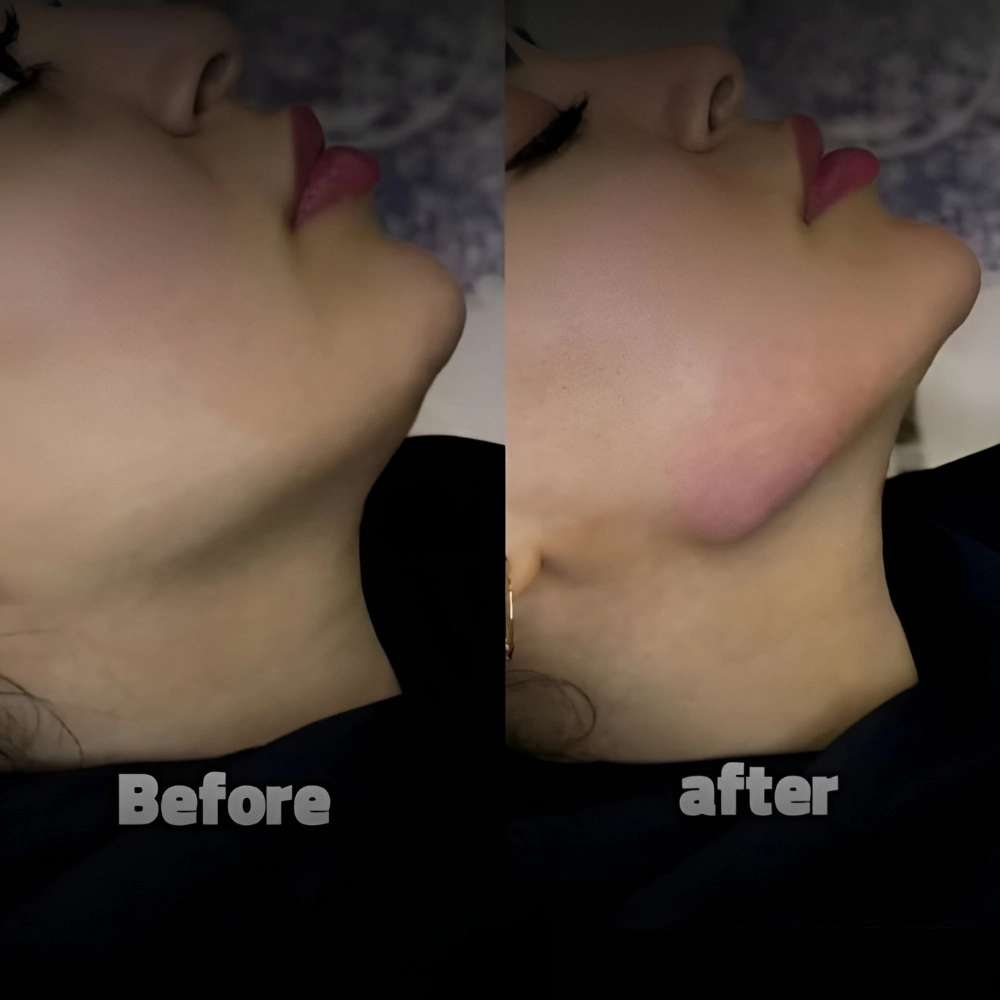 مزونیدلینگ صورت