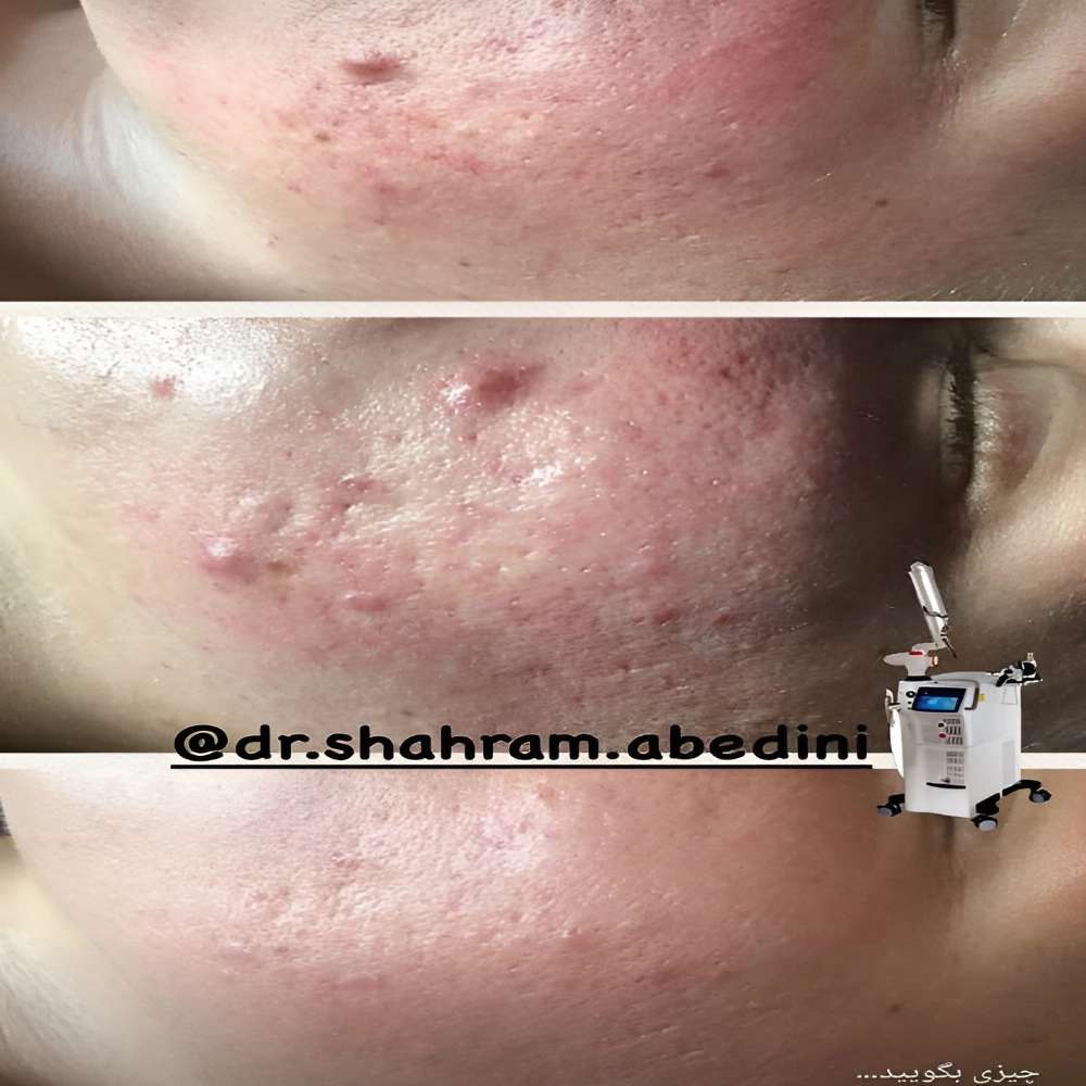 فیلر زیر چشم