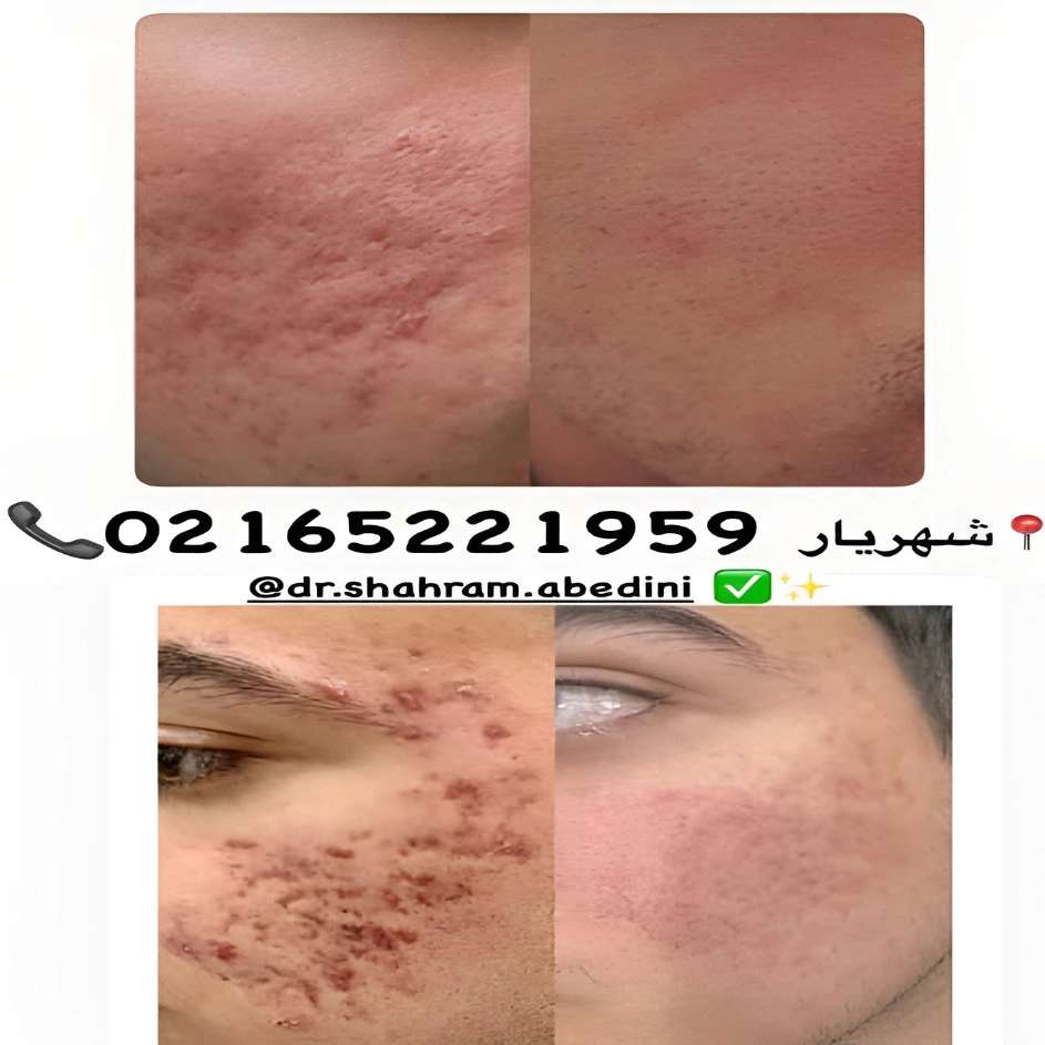 تزریق ژل چانه
