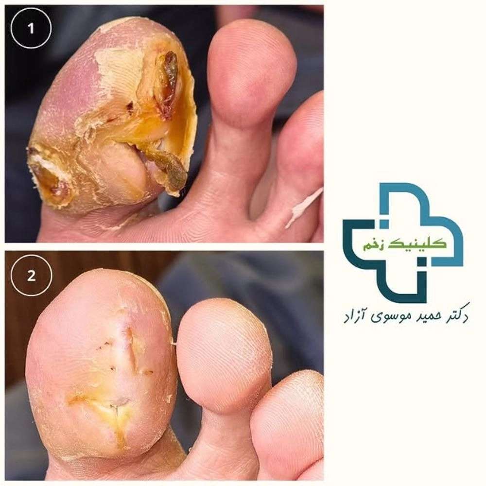 درمان تخصصی زخم های سوختگی