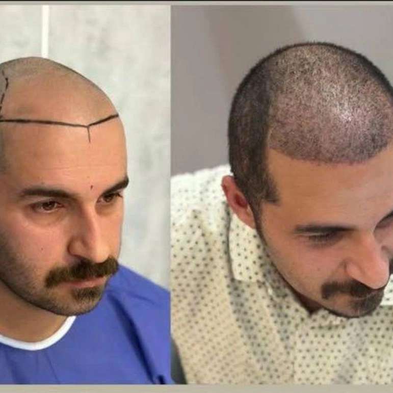 مرکز کاشت رشت رویان