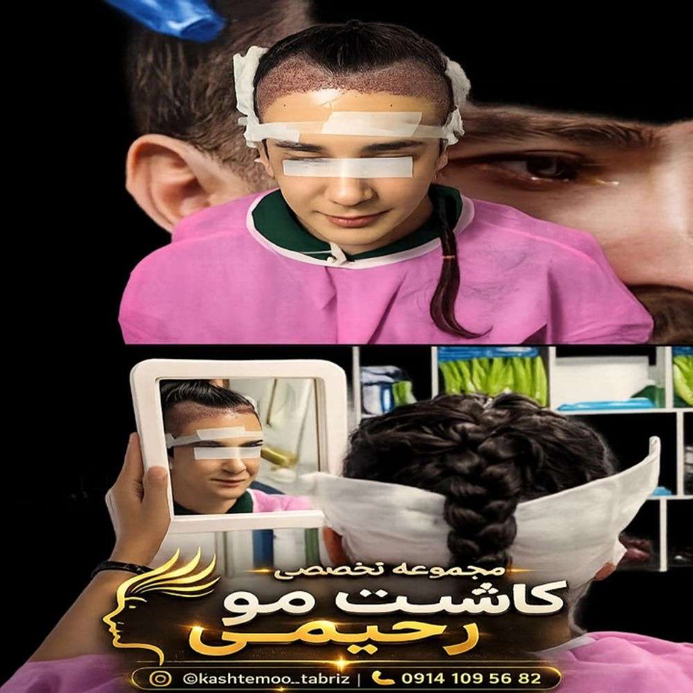 کاشت ابرو تبریز