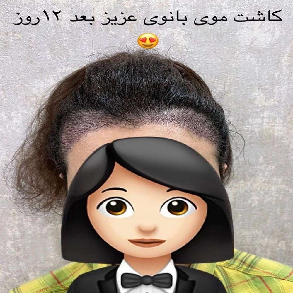 قیمت کاشت مو مردانه