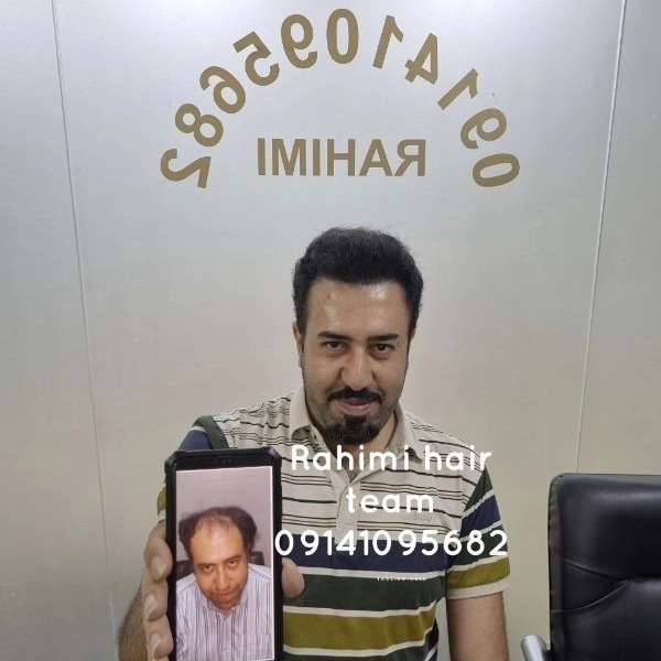 بهترین کلینیک کاشت مو در تبریز
