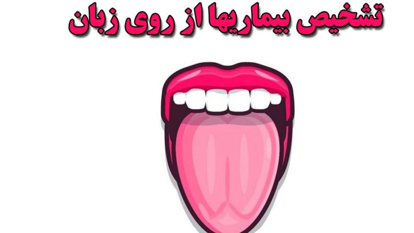 تشخیص بیماری از زبان