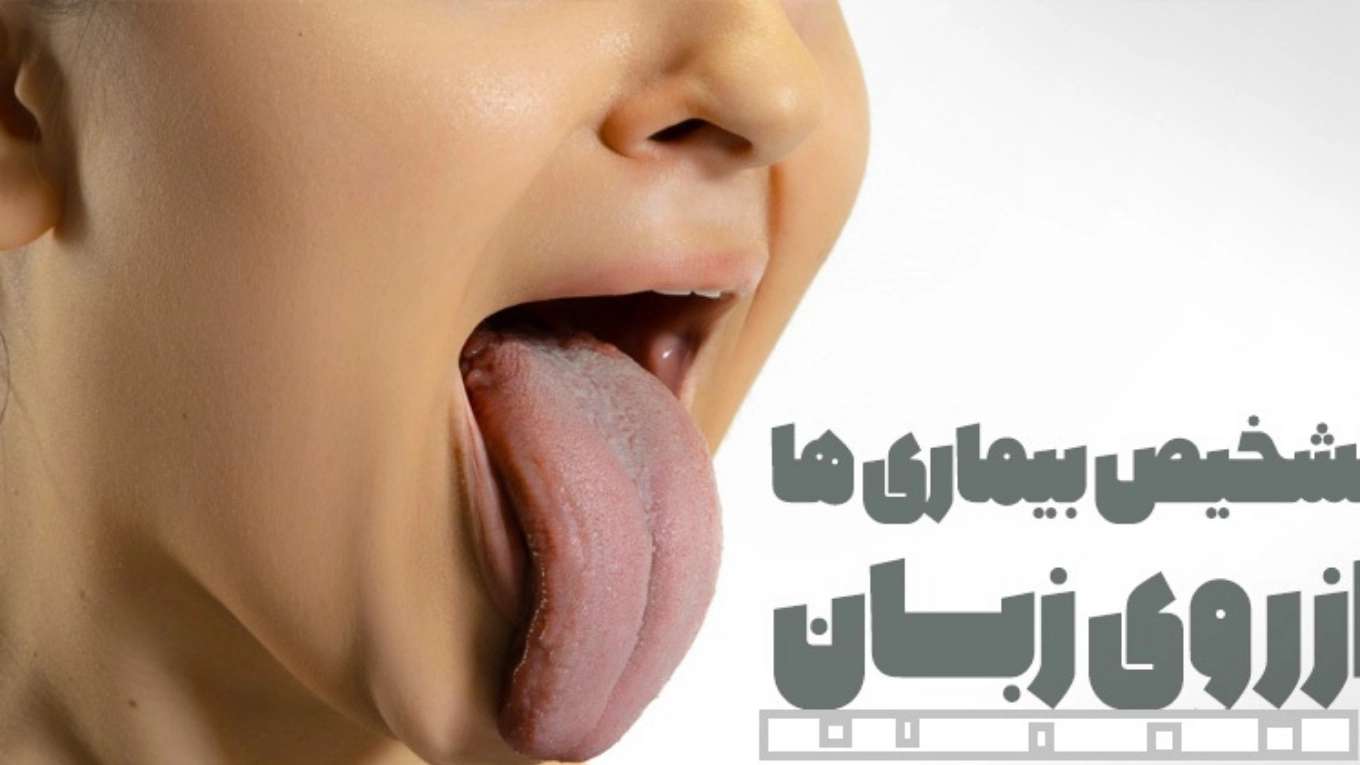 تشخیص بیماری از زبان