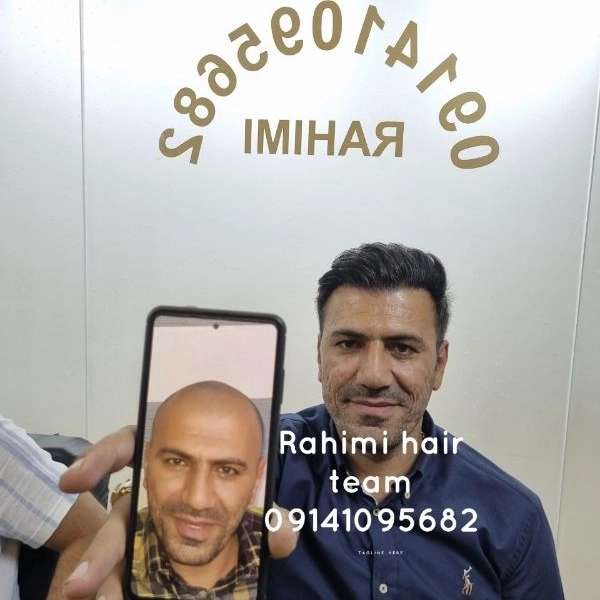 بهترین کلینیک کاشت مو در تبریز