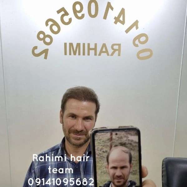 بهترین کلینیک کاشت مو در تبریز