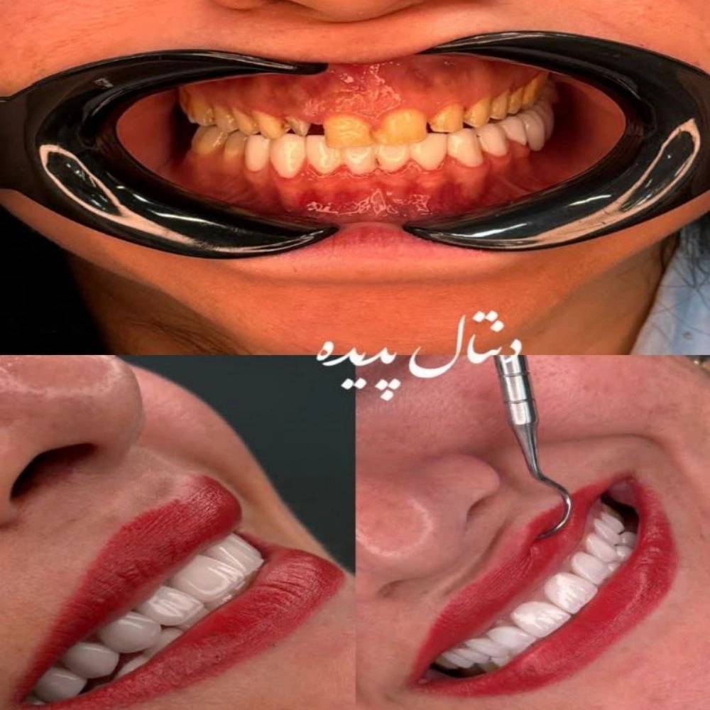 لمینت دندان در تهران